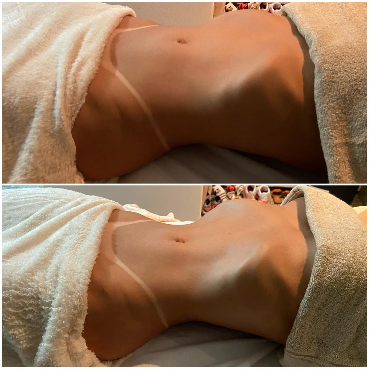 Remodelação Abdominal - Depois