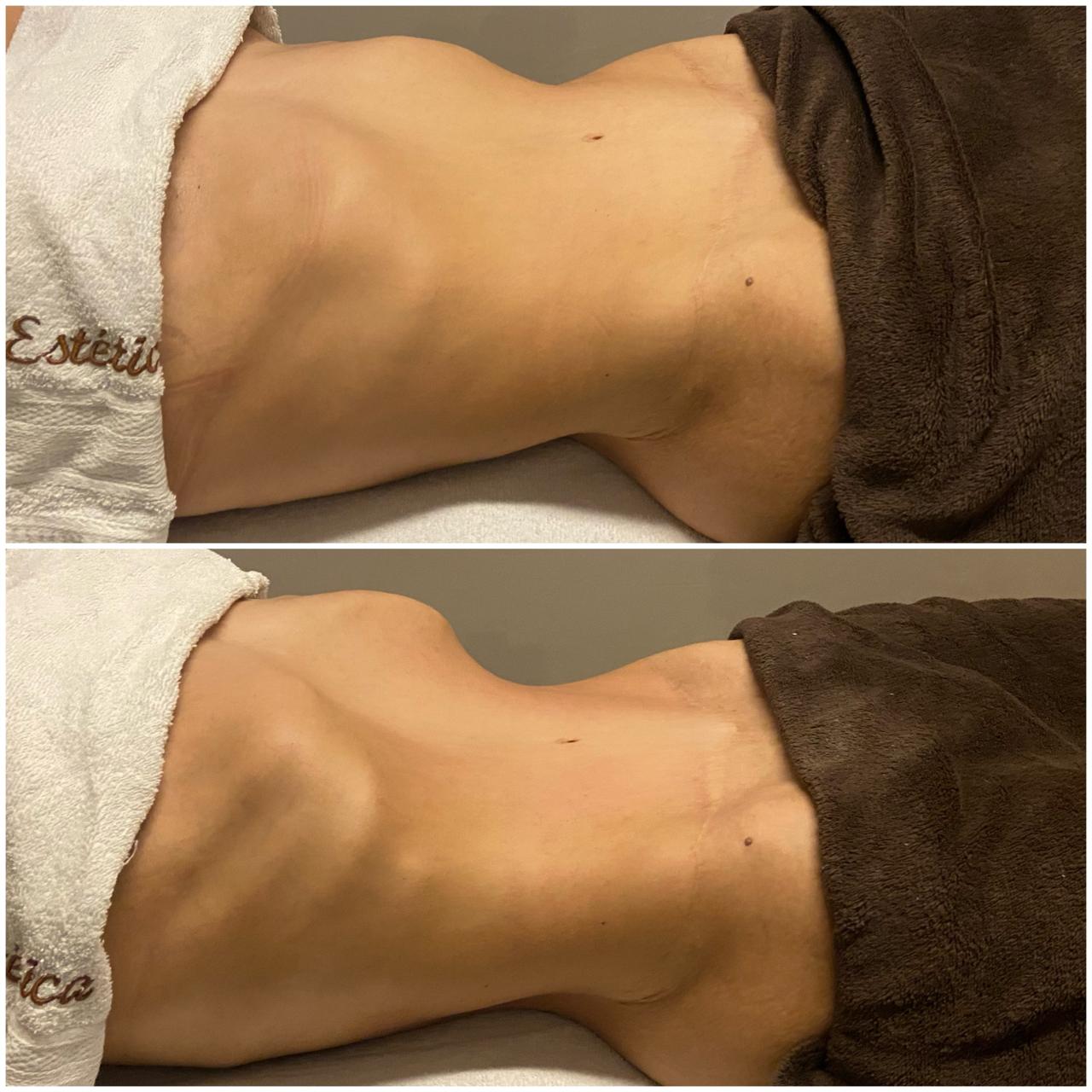 Escultura Corporal - Depois