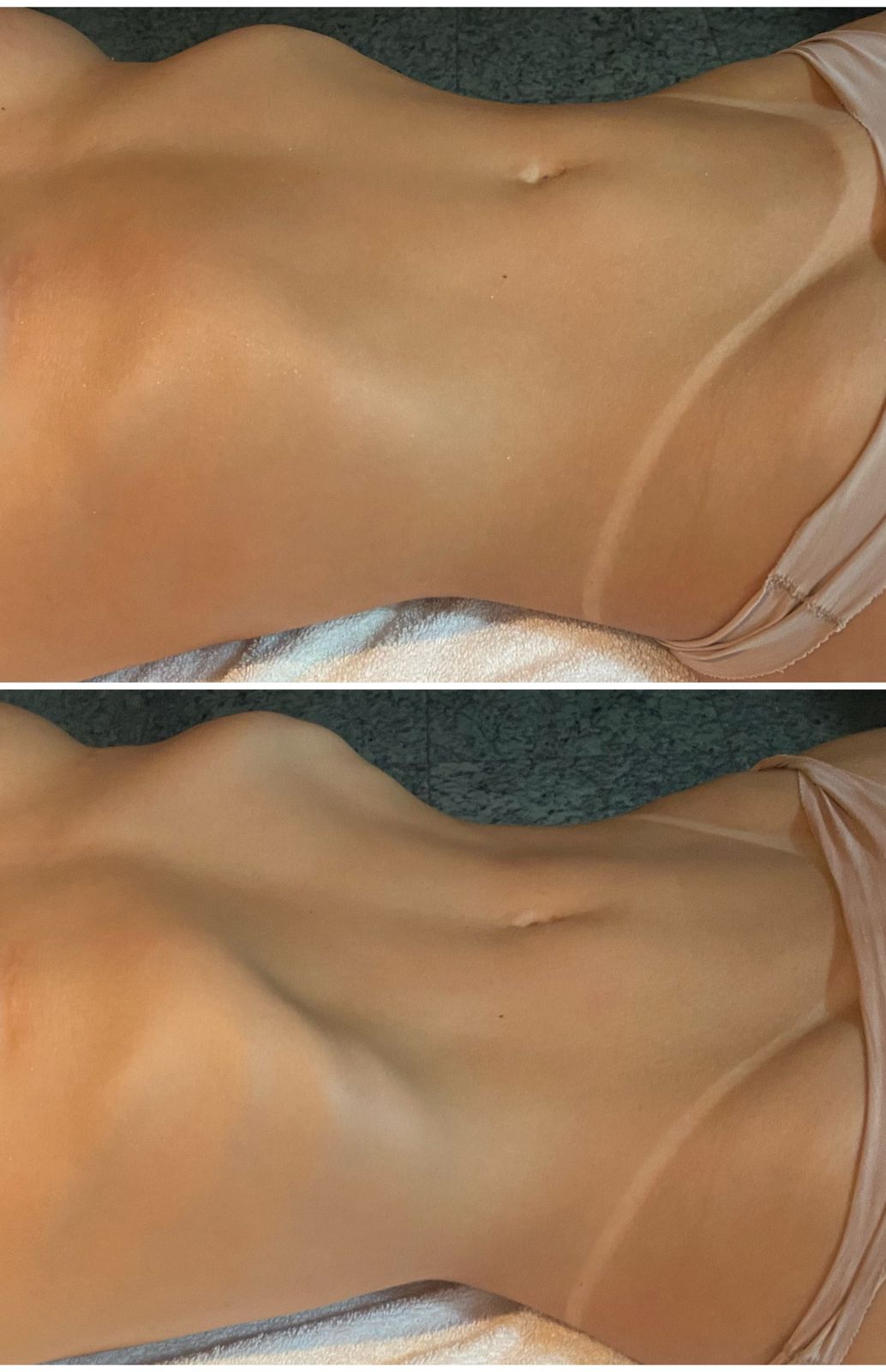 Contorno Corporal - Depois