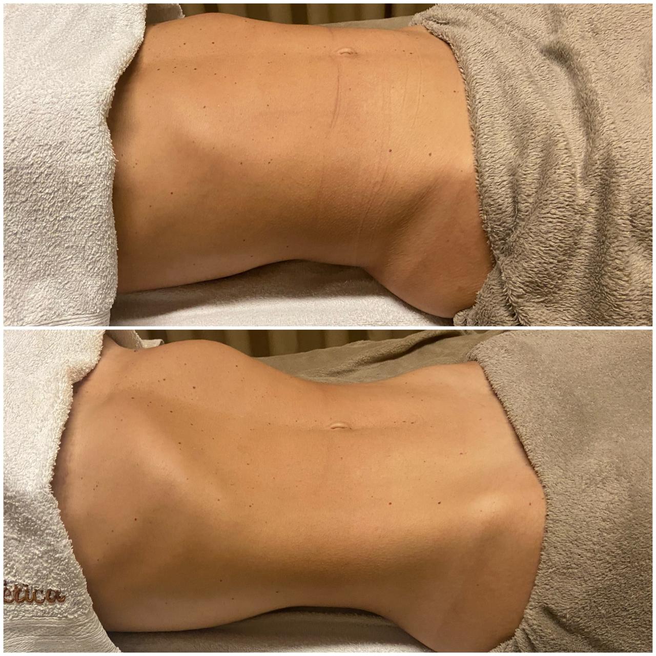 Definição Abdominal - Depois